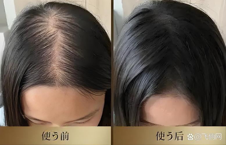 新澳天天彩2025芳草地和频繁洗头脱发是误解与频繁洗头导致脱发